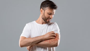 Hives: man scratching hives on arm 1284084384