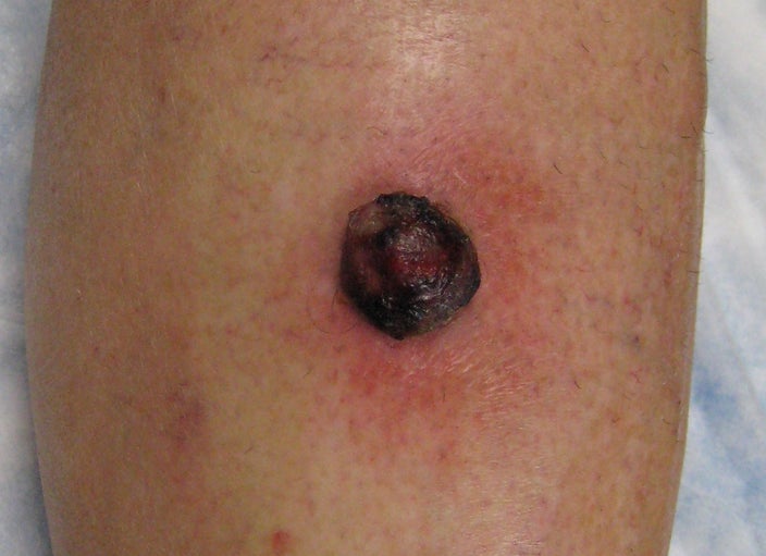 Close-up of a nodular melanoma on the leg. 