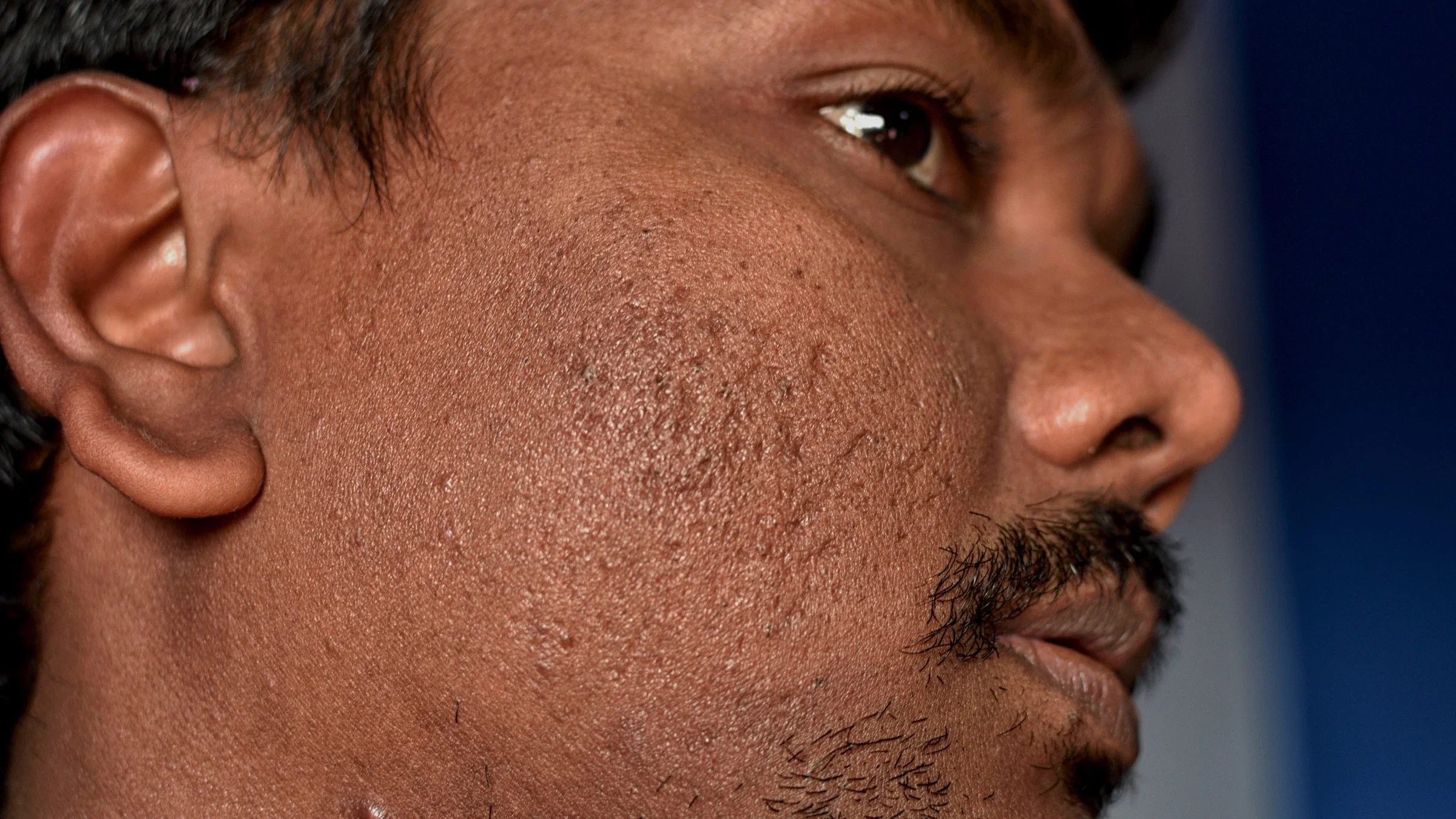 Cropped close-up of a person's face with acne scarring.
SOMNATH MAHATA/iStock via Getty Images Plus