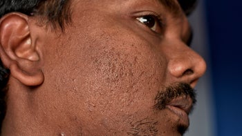 Acne: Scarring: close-up acne scar 1304321910