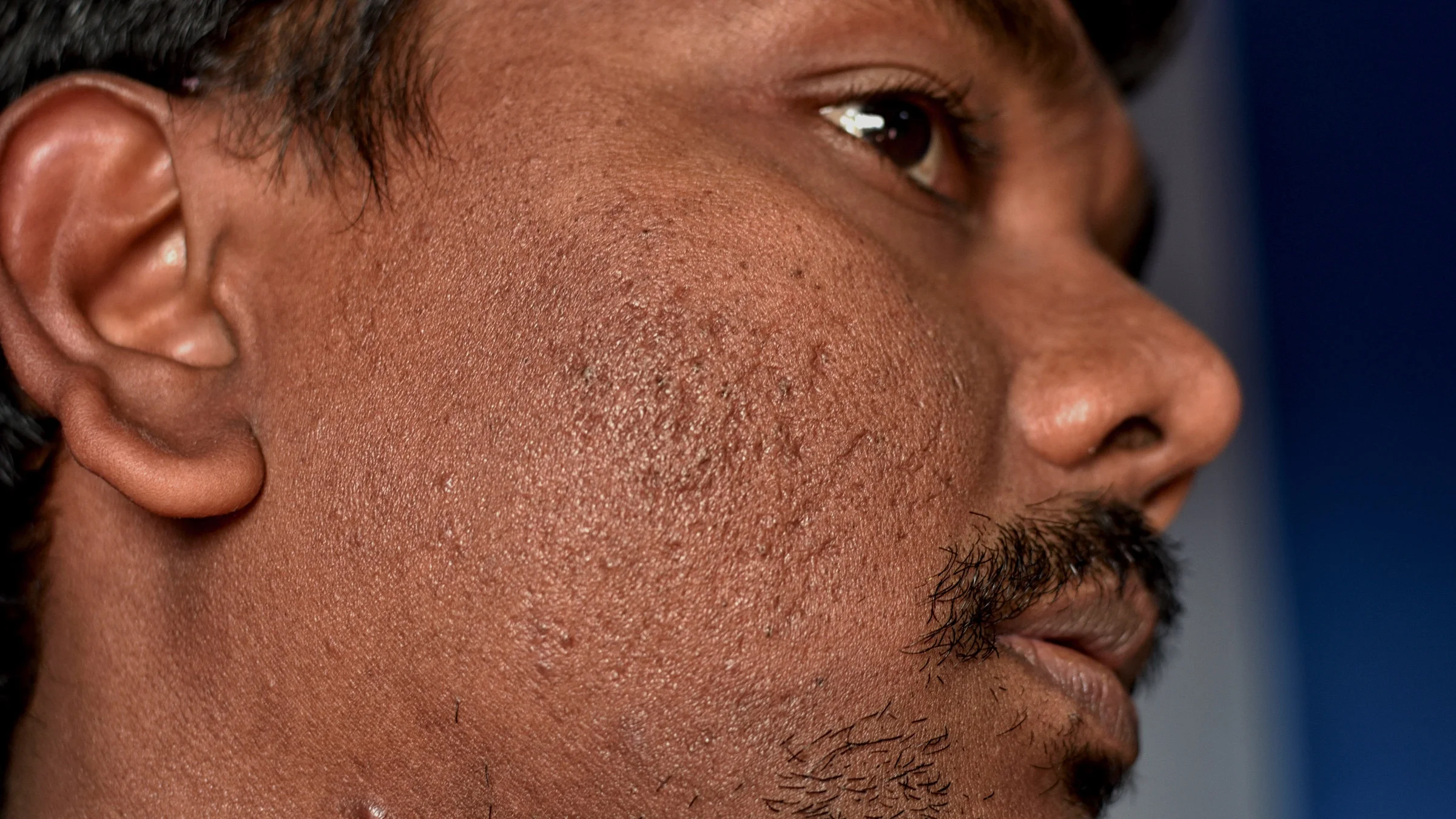 Cropped close-up of a person's face with acne scarring.