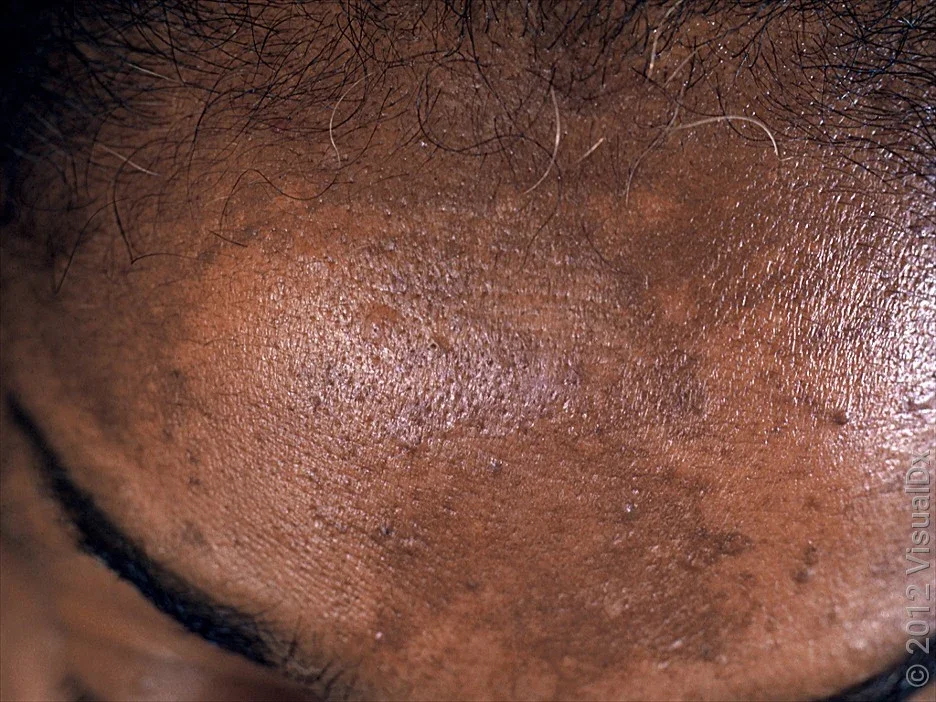 Close-up of melasma on the forehead.