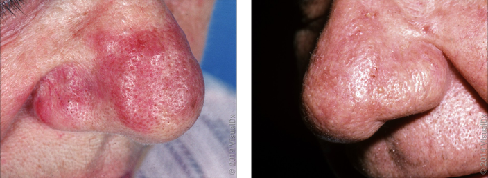Left: Close-up of a nose with red, thickened skin. Right: Close-up of a nose with dark patches and prominent pores.