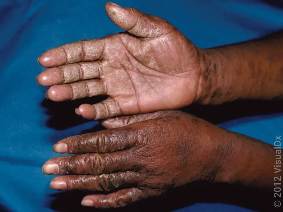 Close-up of hands with an allergic reaction.