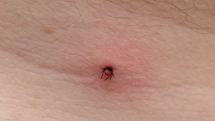 Close-up tick bite on skin.
