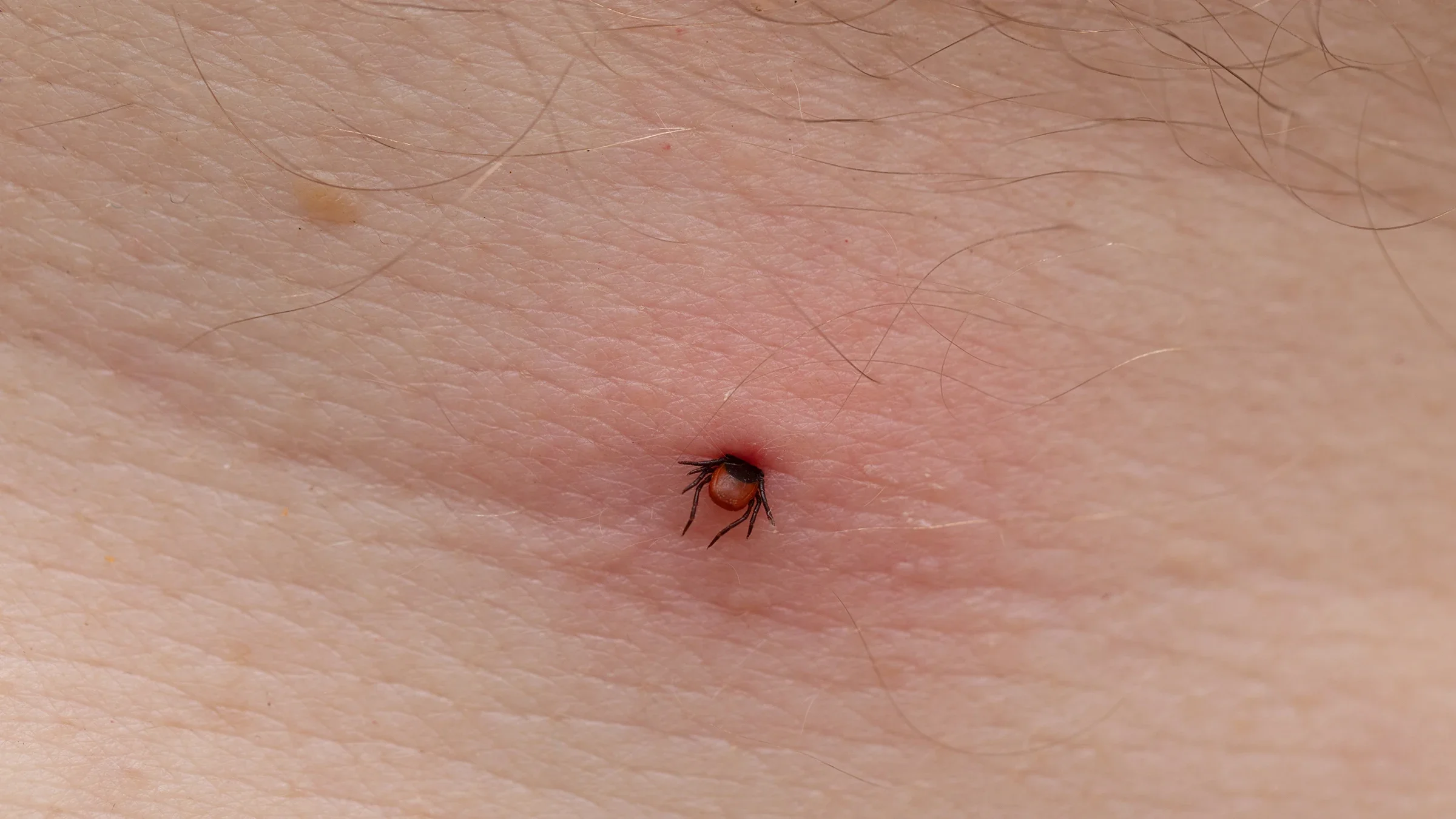 Close-up tick bite on skin.
Ocskaymark/iStock via Getty Images Plus