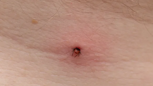 Lyme Disease: closeup tick bite on skin 1347669736