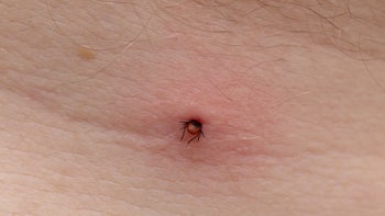 Lyme Disease: closeup tick bite on skin 1347669736