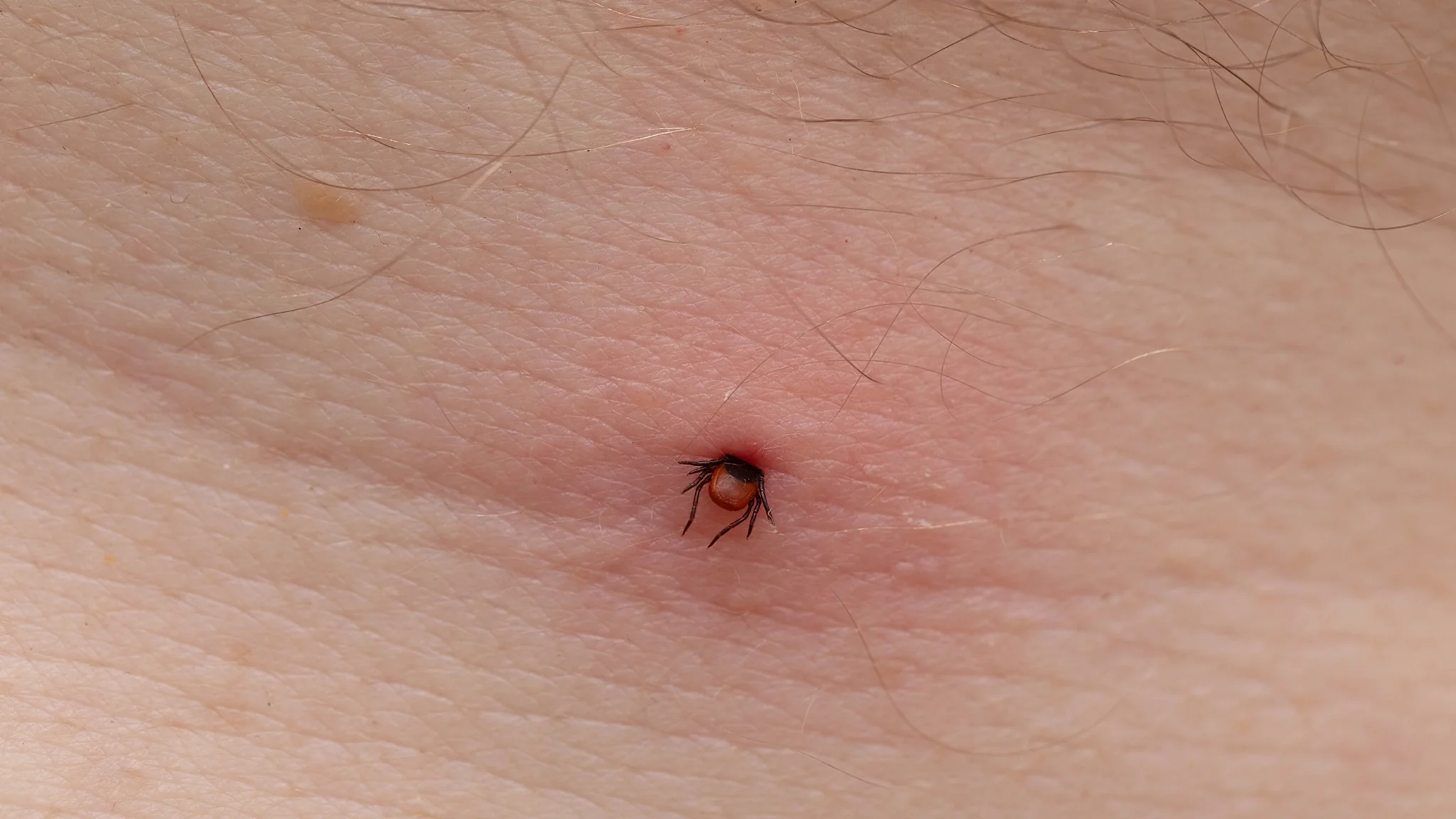 Close-up tick bite on skin.
