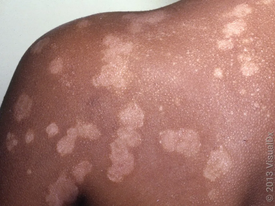 White skin patches caused by post-inflammatory hypopigmentation from chickenpox.