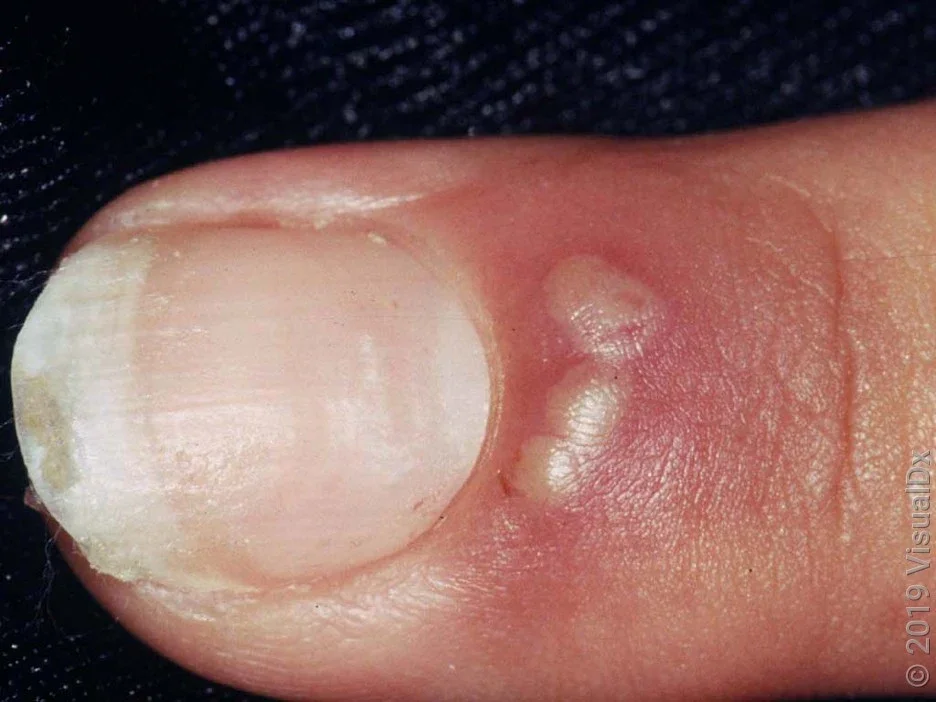 Close-up of a fingertip with a herpes infection, two small pus bumps on the nail bed.