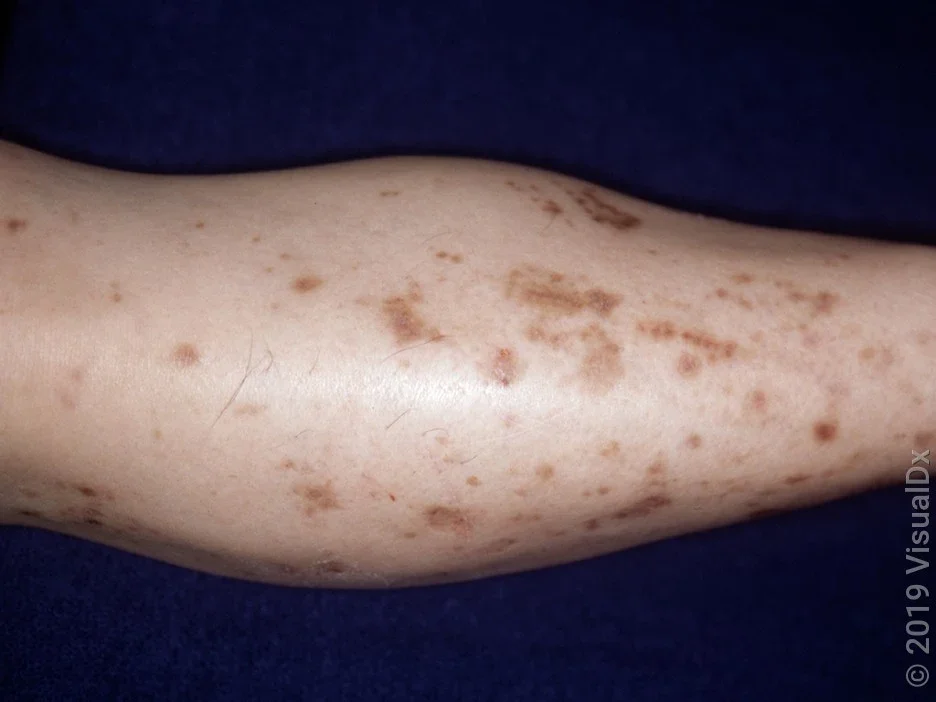 Brown patches caused by diabetic dermopathy.