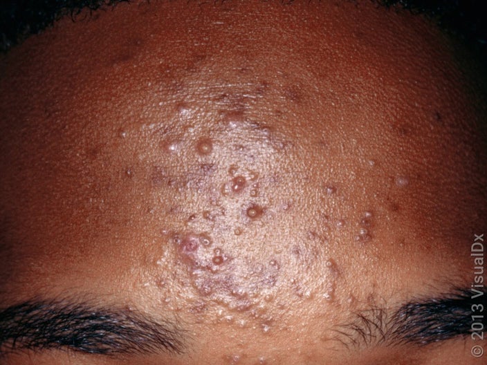 Inflammatory acne on the forehead with many bumps, some filled with pus. 