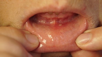 side-effects: oral: mouth: closeup of person showing oral sore-823814060