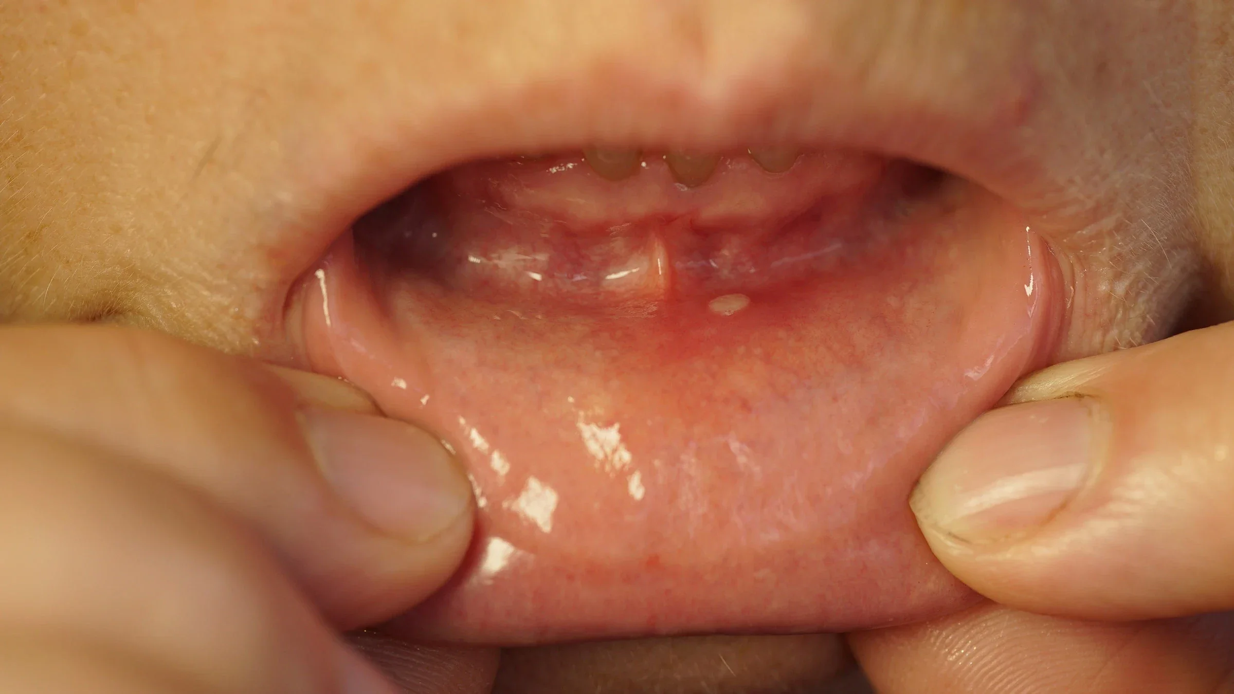 Close-up of a person pulling their bottom lip down to show an oral sore.
epifan_vn/iStock via Getty Images