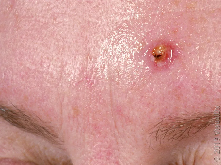 A squamous cell carcinoma on the forehead in fair skin.