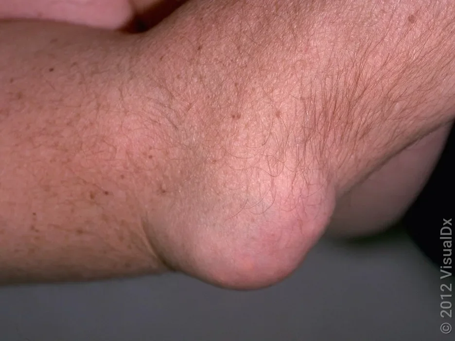 A large tophus on the elbow.