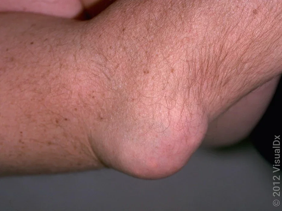 A large tophus on the elbow.