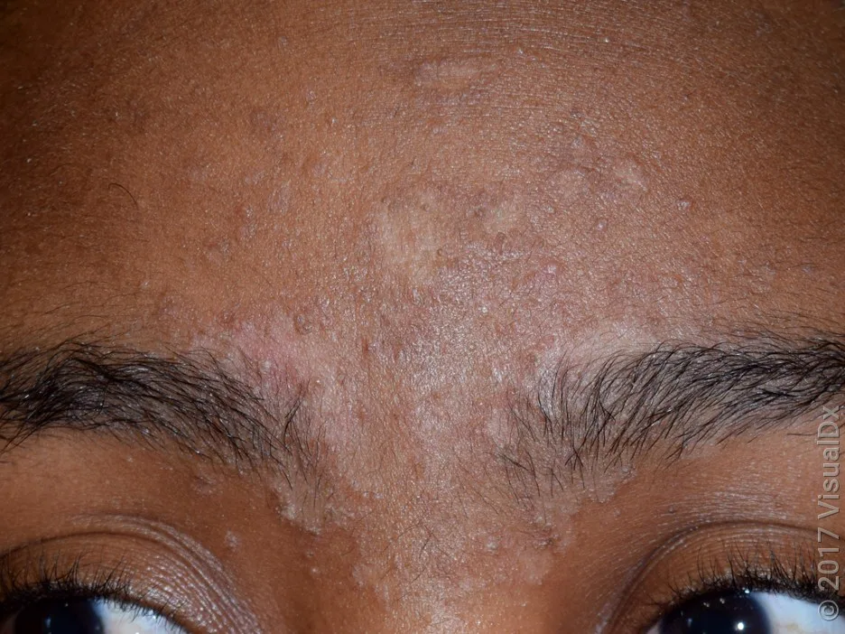 Dandruff causes red, discolored, and flaky eyebrows.