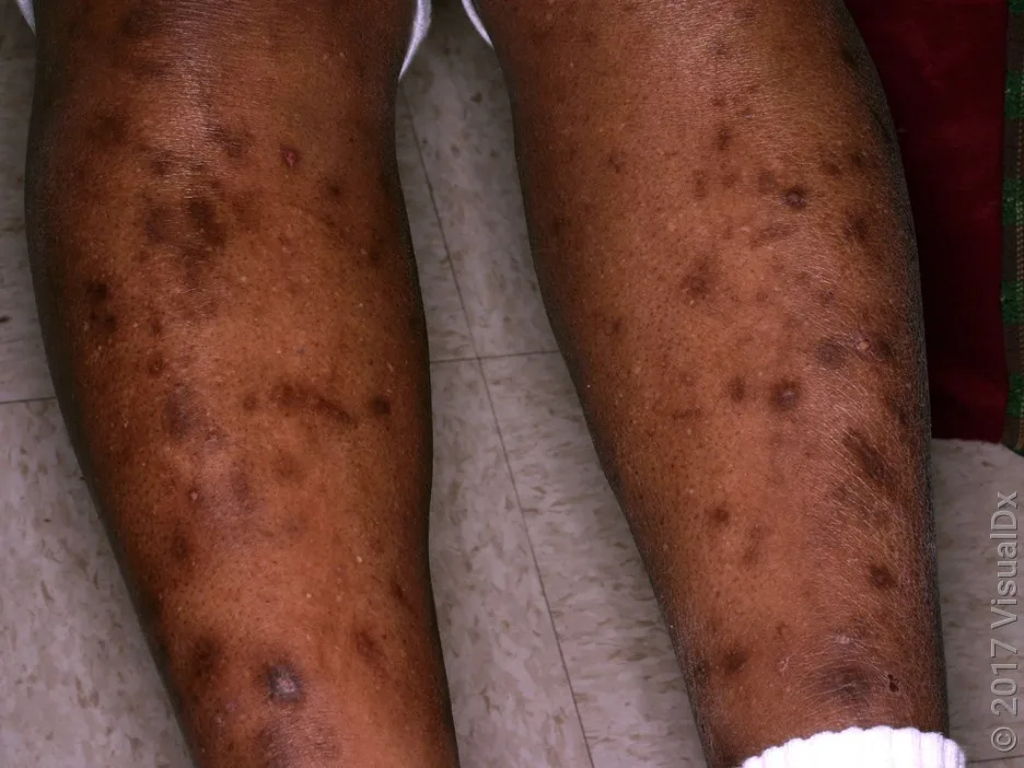 Close-up of many bedbug bites on the leg.