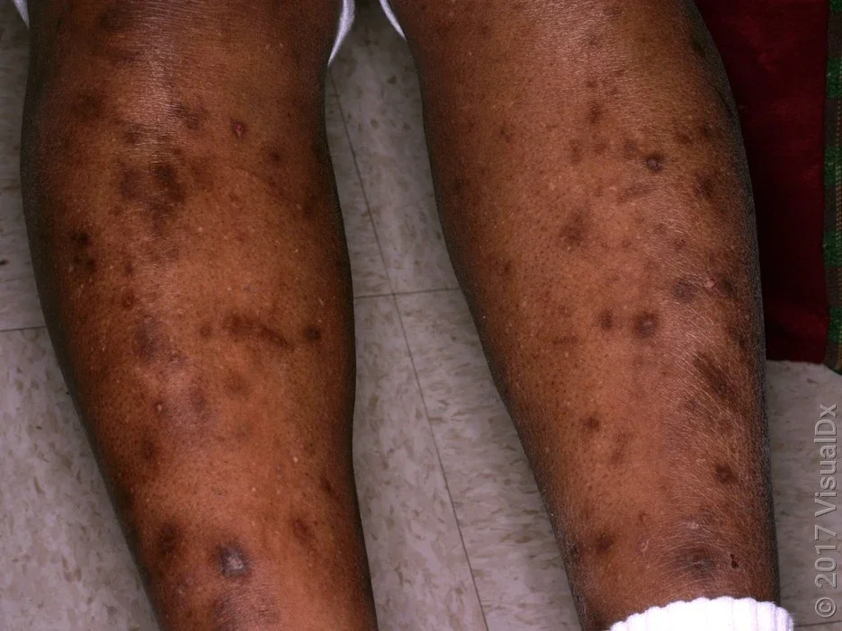 Close-up of many bedbug bites on the leg.