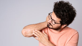 Dupixent: man with eczema on elbow 1324722235