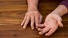 People with psoriatic arthritis may be eligible for Social Security disability benefits. Learn more about how to apply and what criteria you must meet, with GoodRx.