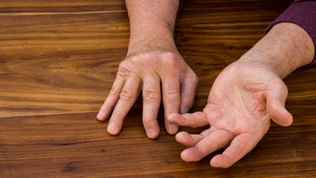 Health: psoratic arthritis hands-1333218136