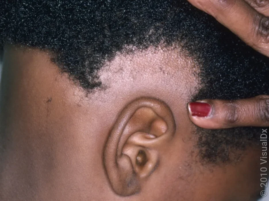 Close-up of alopecia areata hair loss on the side of the scalp. 