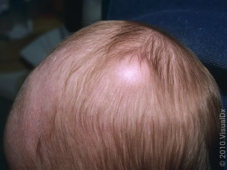 Close-up of a lipoma on the head. 