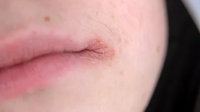 Eczema: eczema on lips 1204472724