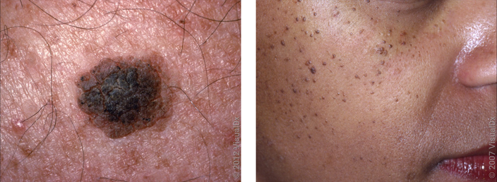 Left: Close-up picture of a large, round, rough skin bump. Right: May small tan and brown skin bumps on the cheek. 