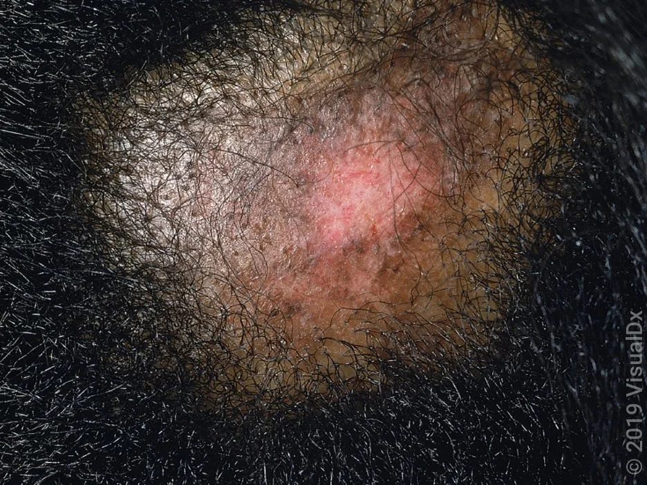 Discoid lupus on the scalp that has caused hair loss.