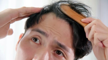 Hair loss: man with hair loss 1402866793