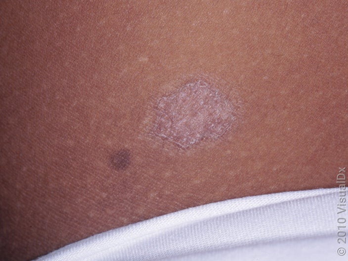 Close-up of a superficial basal cell carcinoma skin cancer on darker skin. 