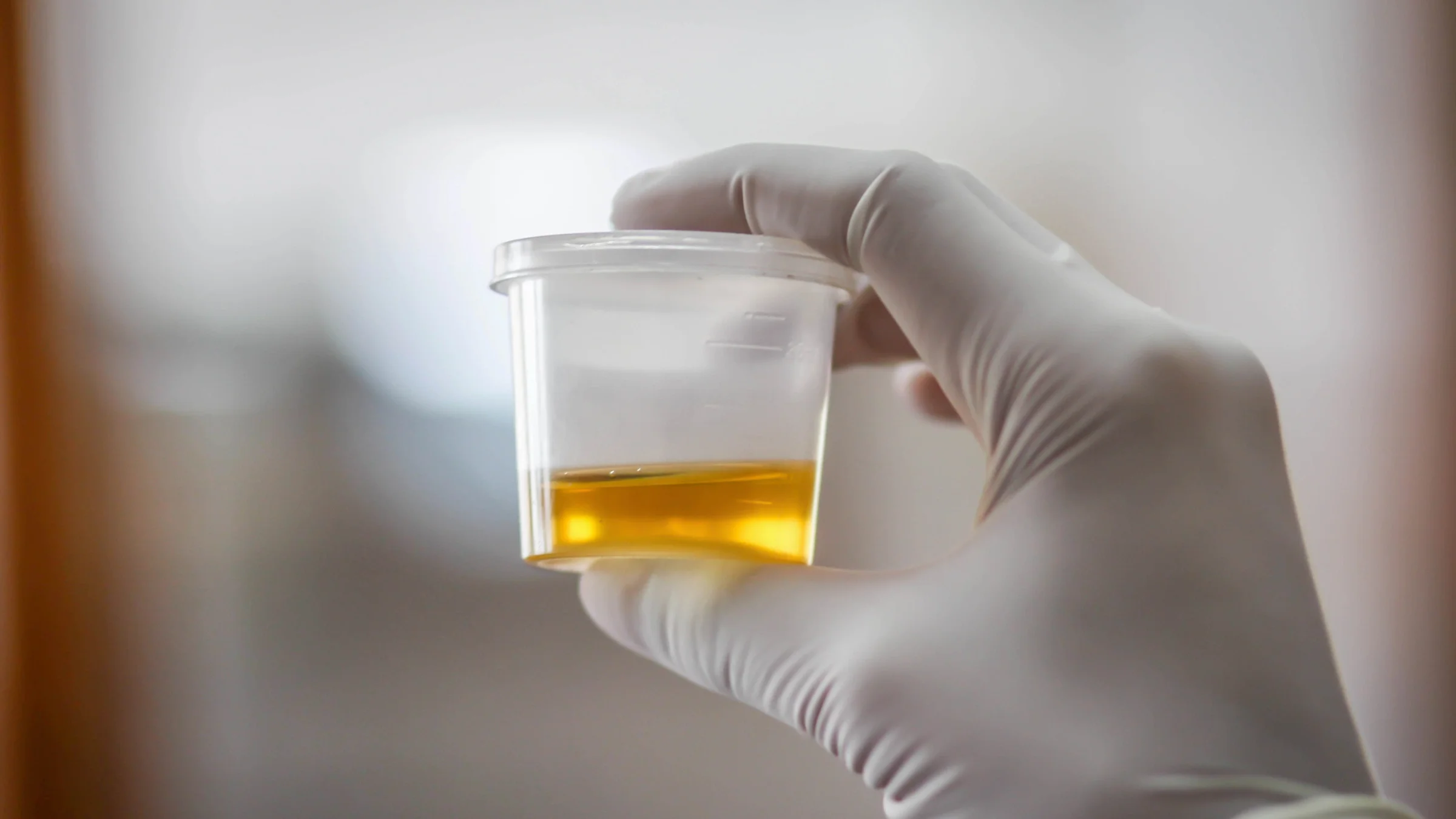 Close-up on a urine sample cup being held by a nurse with a gloved hand.