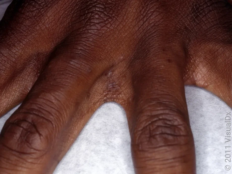 A hand with tiny dark brown bumps on the fingers and in the web spaces.