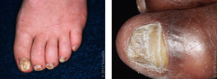 Left: Toes with thickened nails from fungus. Right: Close-up of a thickened nail from fungus.