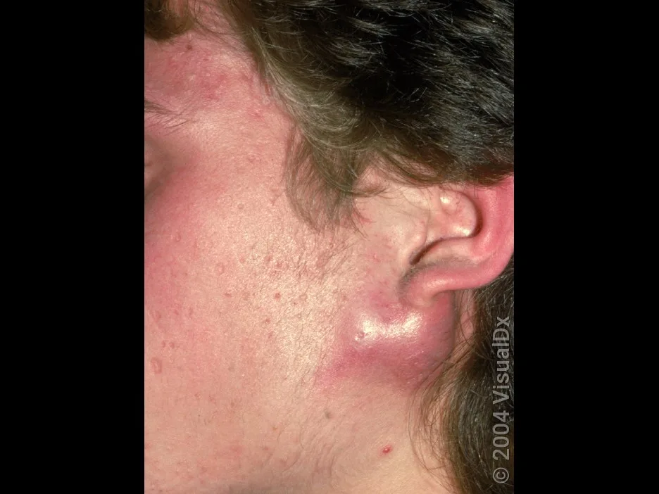 Close-up of a large acne cyst under the ear.