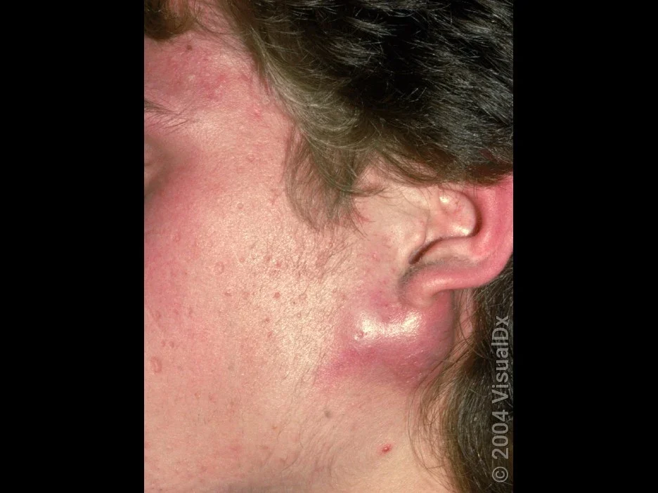 Close-up of a large acne cyst under the ear. 