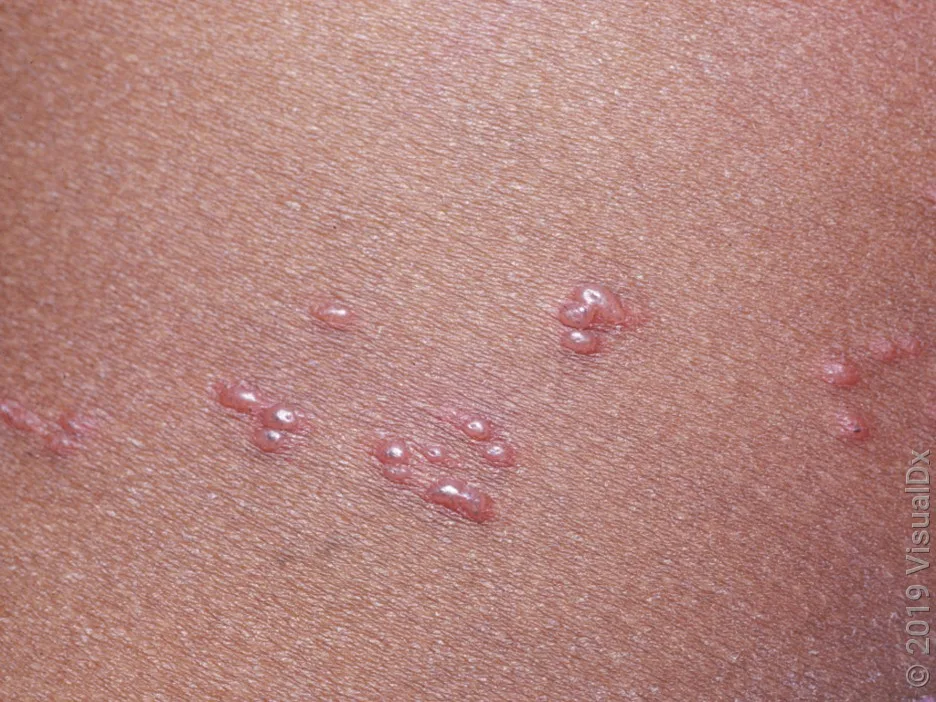 Close-up of blisters (vesicles) in shingles rash. 