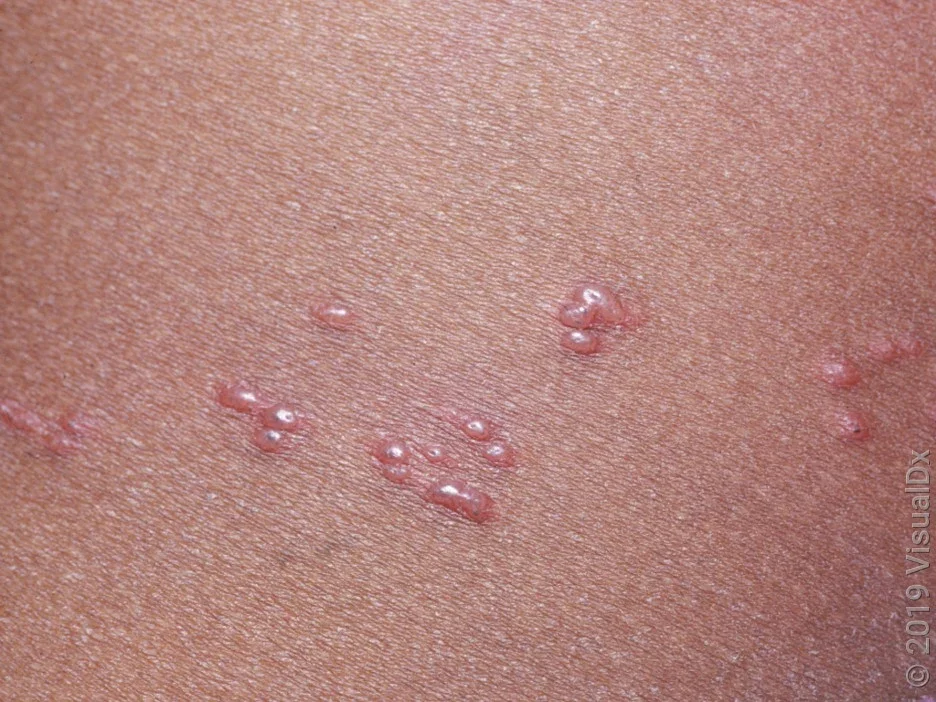 Close-up of blisters (vesicles) in shingles rash. 