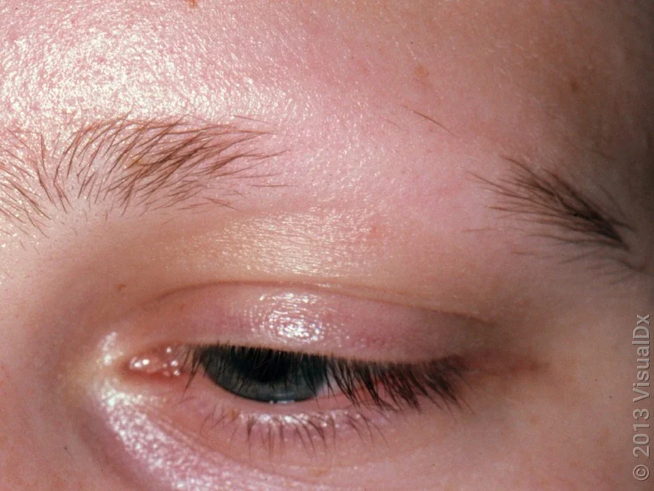 Close-up of alopecia areata hair loss on the eyebrow.