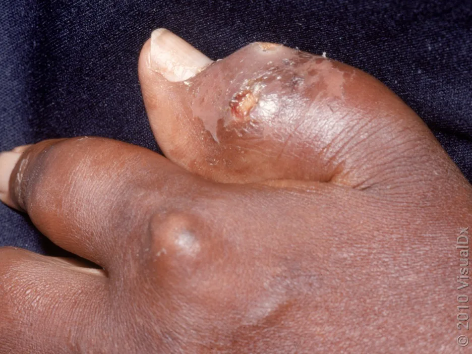 Gout affecting the thumb and finger. 