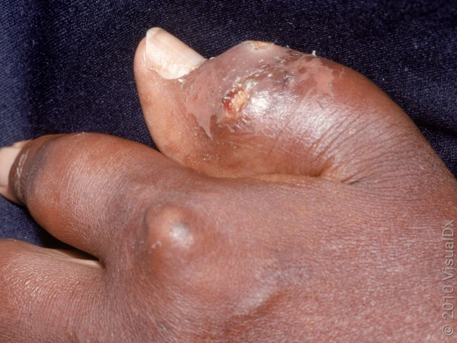Gout affecting the thumb and finger.