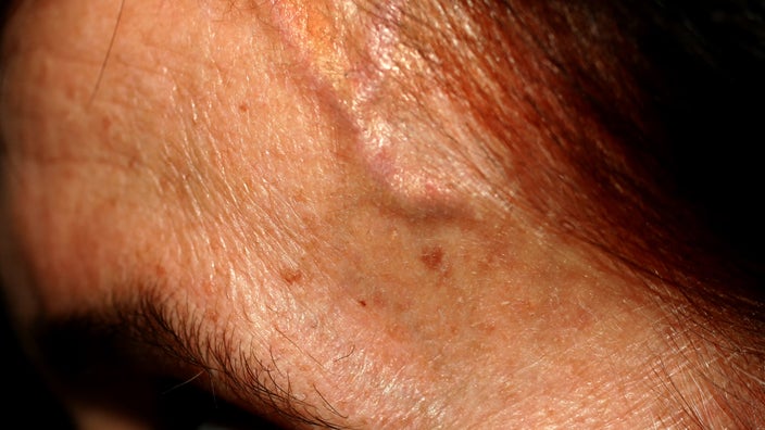 A close-up of veins bulging on a person’s temple.