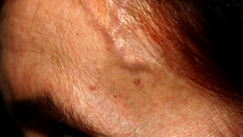 Headaches: Giant Cell Arteritis: forehead veins-889719902