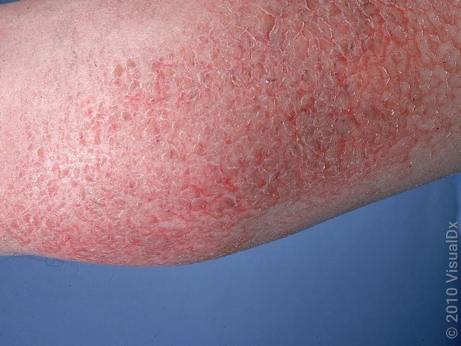 Asteatotic eczema on the leg. 