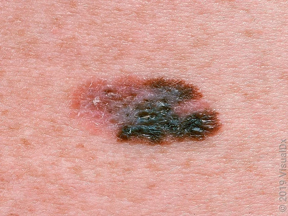 Close-up of a melanoma on fair skin. 