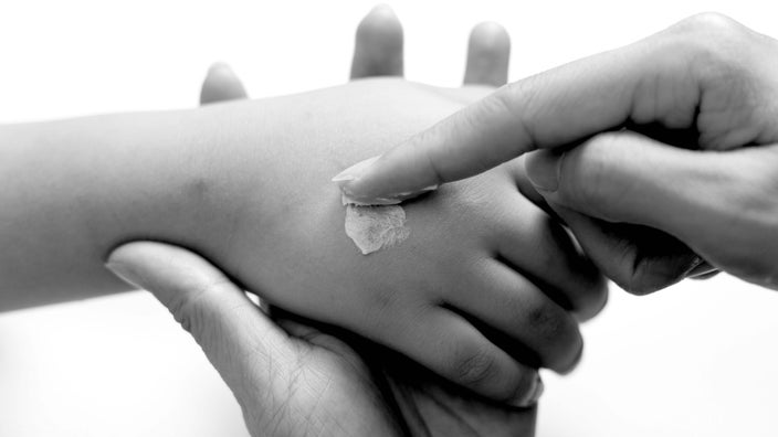 Close-up of a parent applying antihistamine cream to a child's hand.